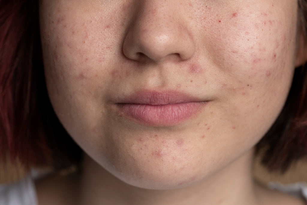 5 Skincare Products to Get Rid of Dark Spots and Acne Scars